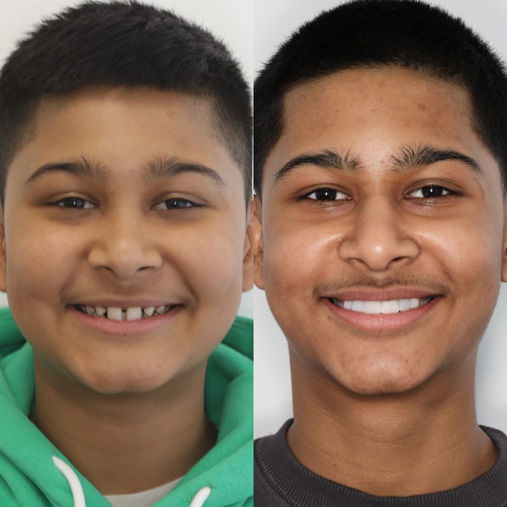 before and after of a child after composite bonding, metal braces and teeth replacement at skintique beautiful smiles