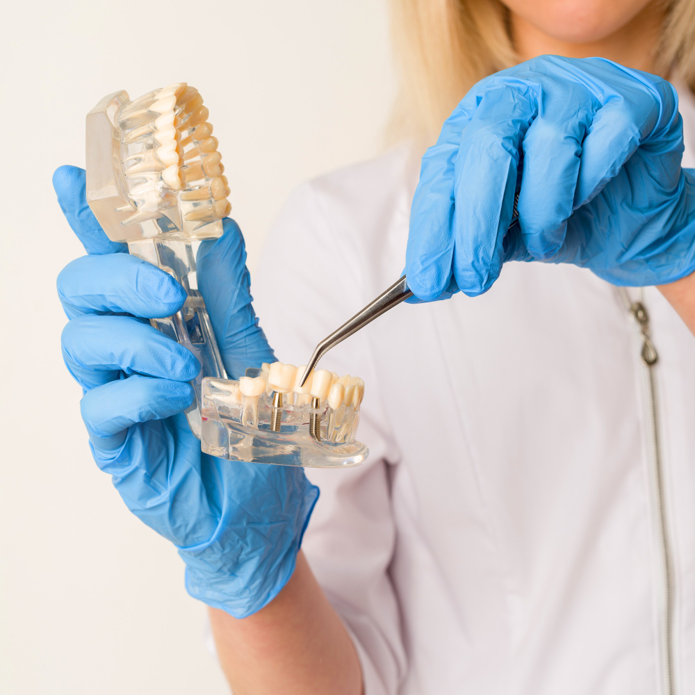 dental implants presentation