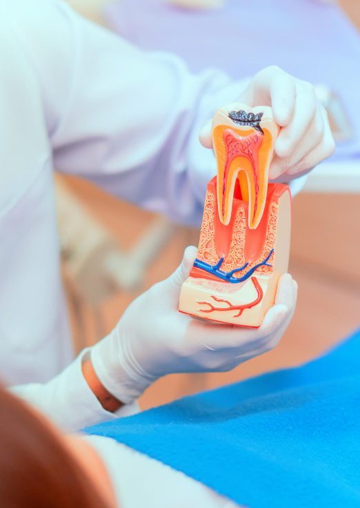 presentation of root canal treatment by dentist