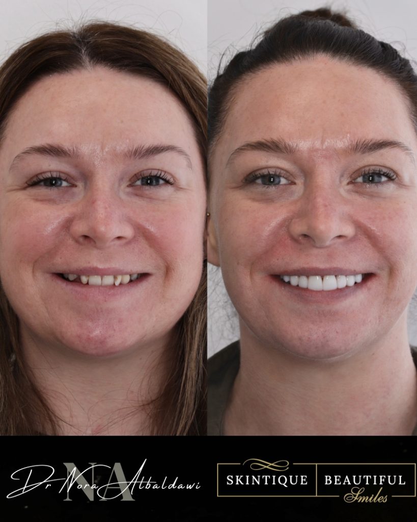 before and after composite bondg, teeth whiteing and damon clear braces cosmetic dentry