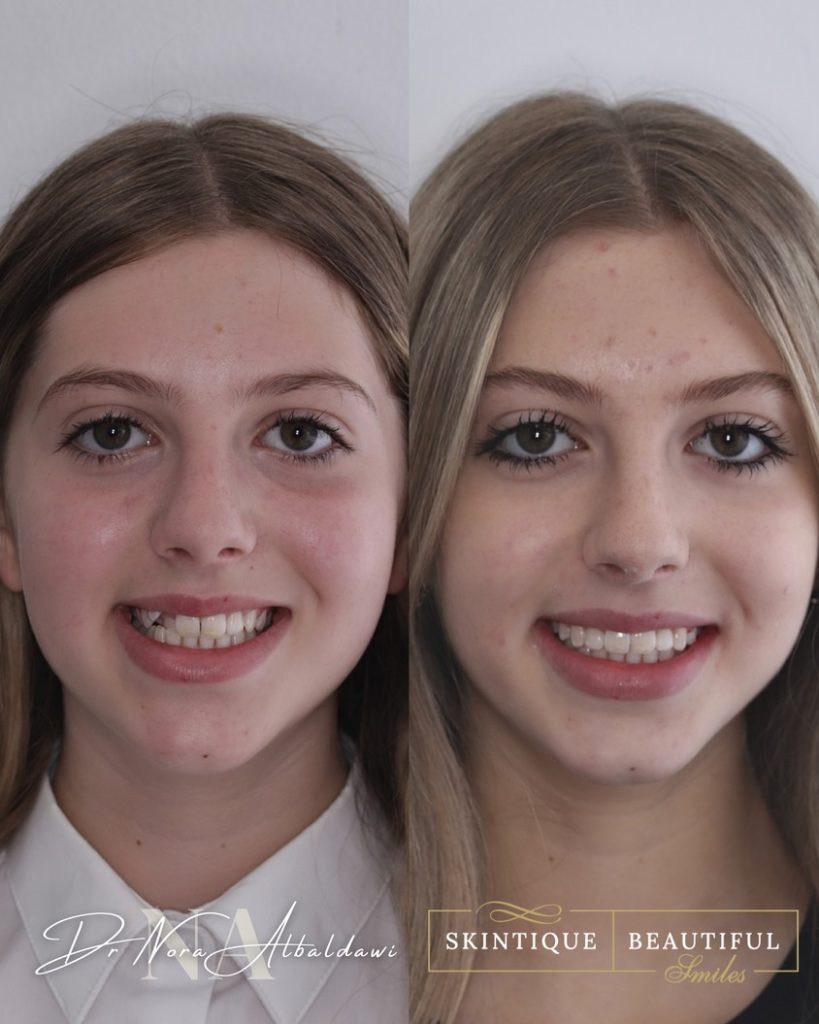 Brooke's before and after metal braces