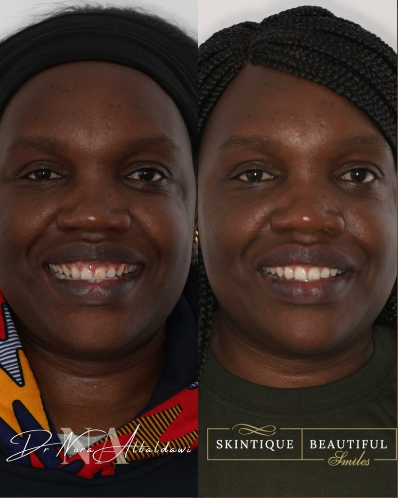 Lisa's before and after laser countouring