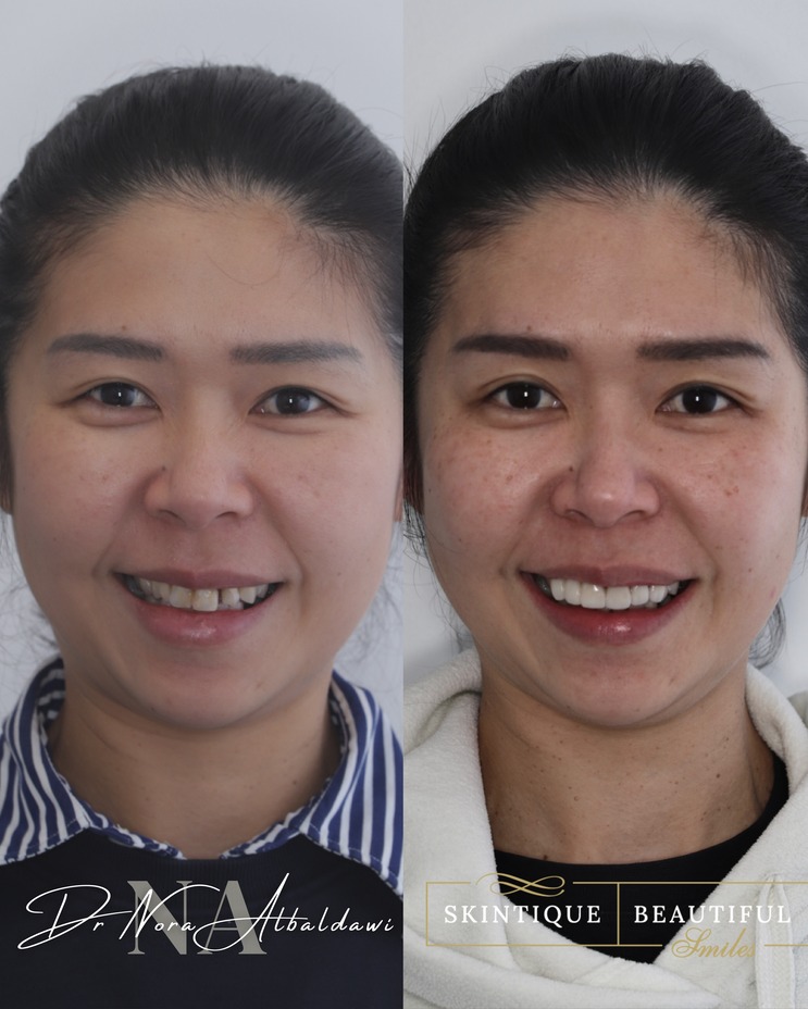 before and after damon braces and emax crowns