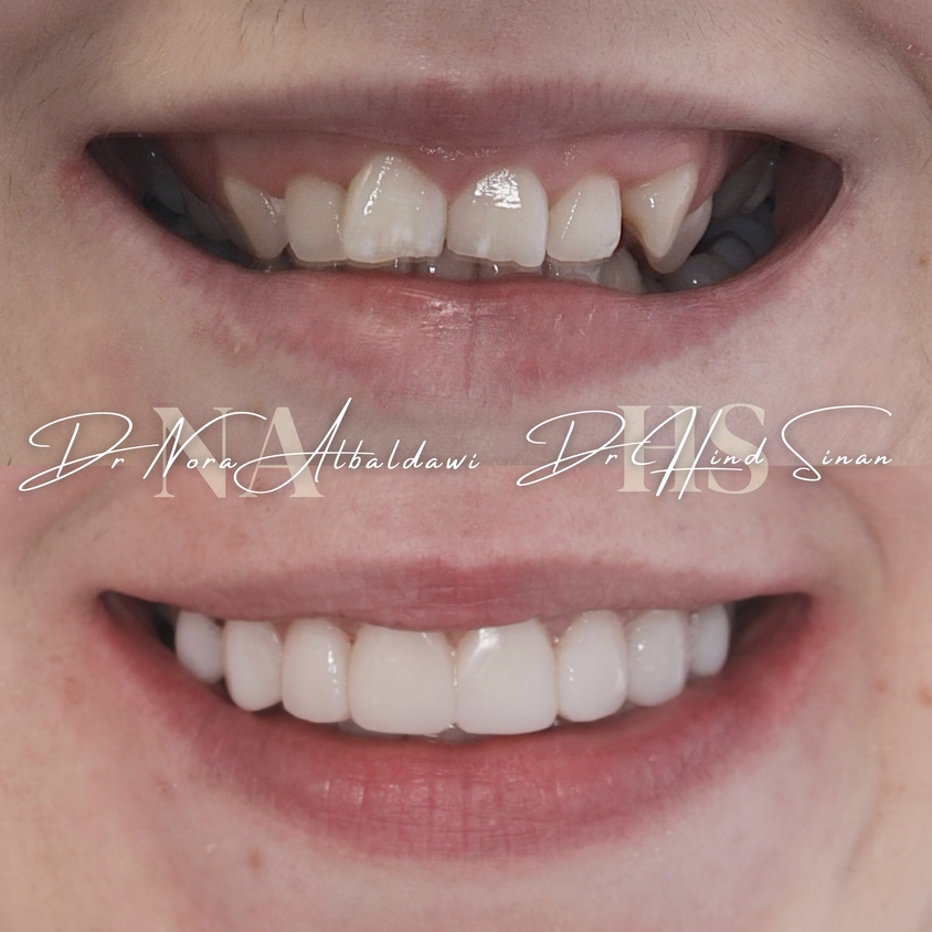 Sam's before and after composite bonding