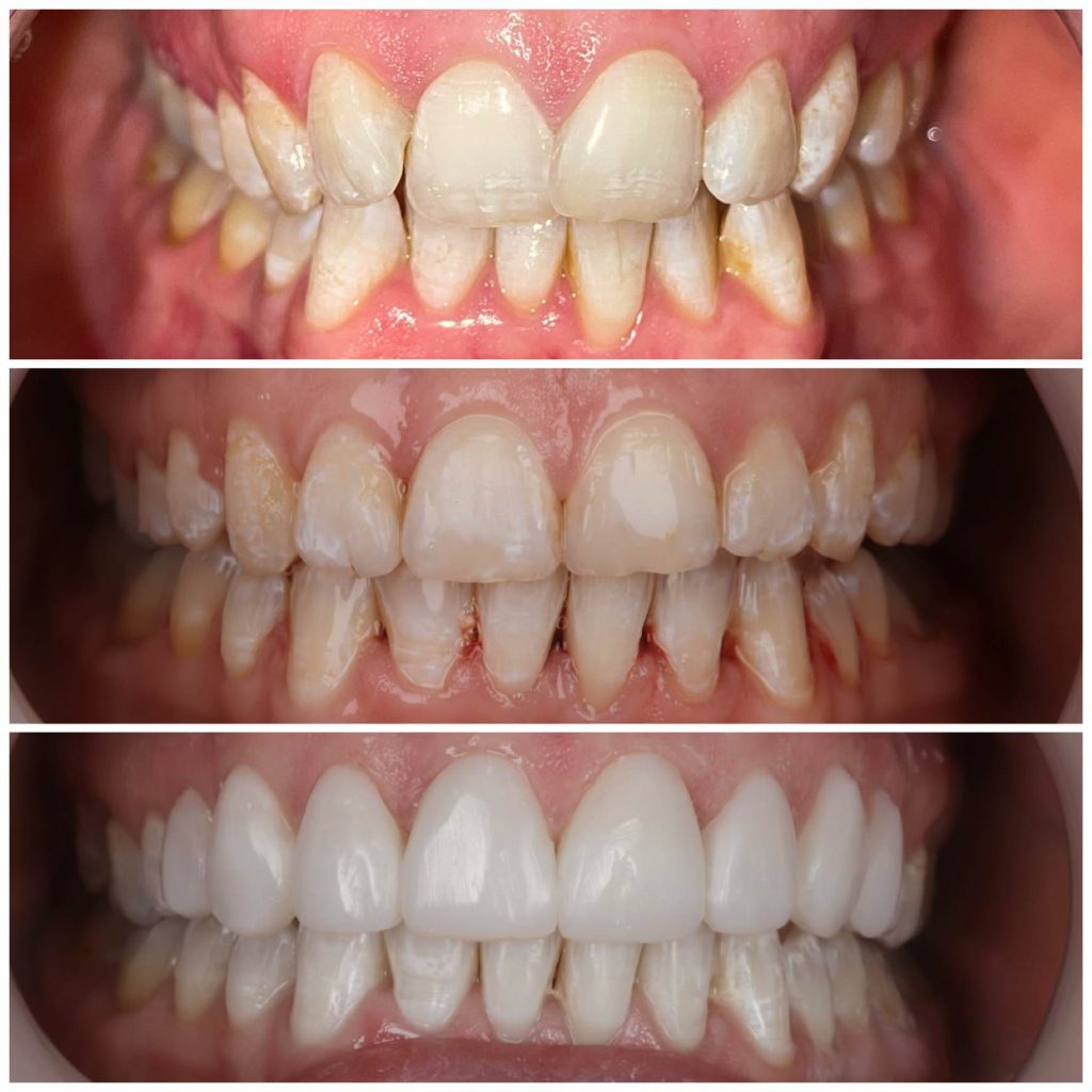 sam journey of before and after composite bonding