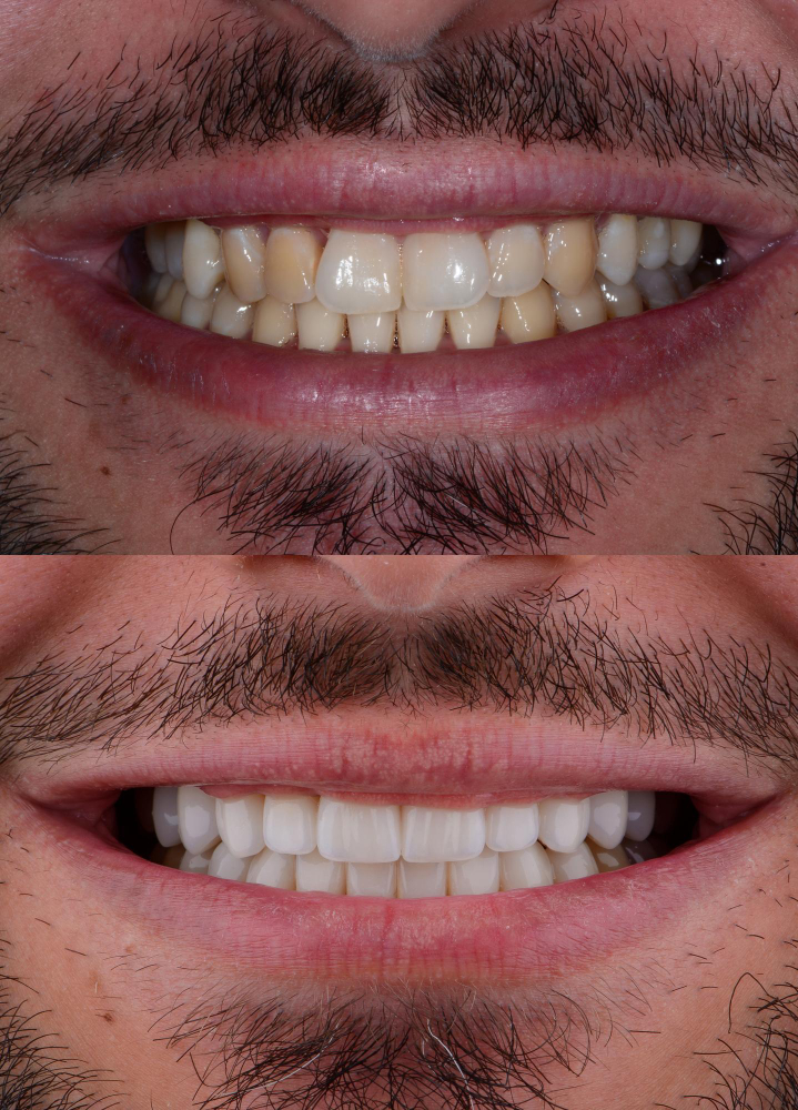 before and after natural looking veneers