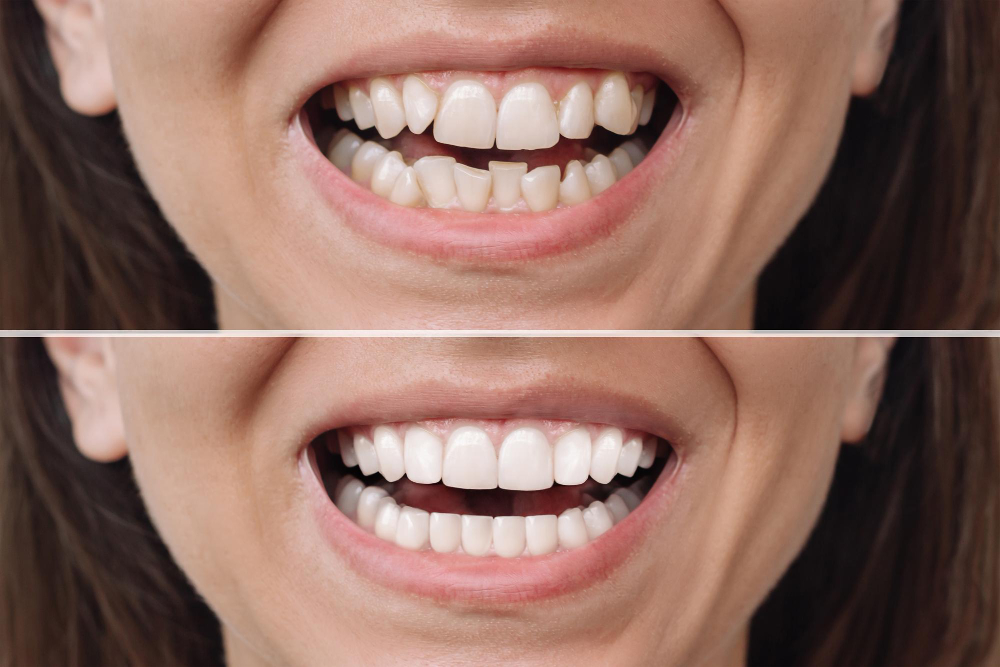 before and after veneers installation
