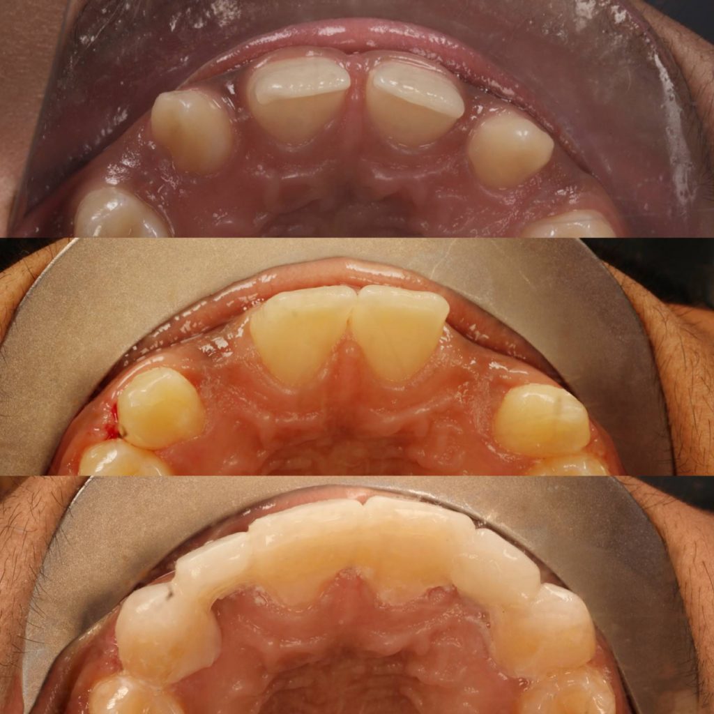 before and after composite filling bonding