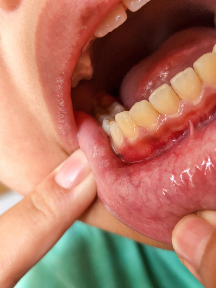 bleeding gums