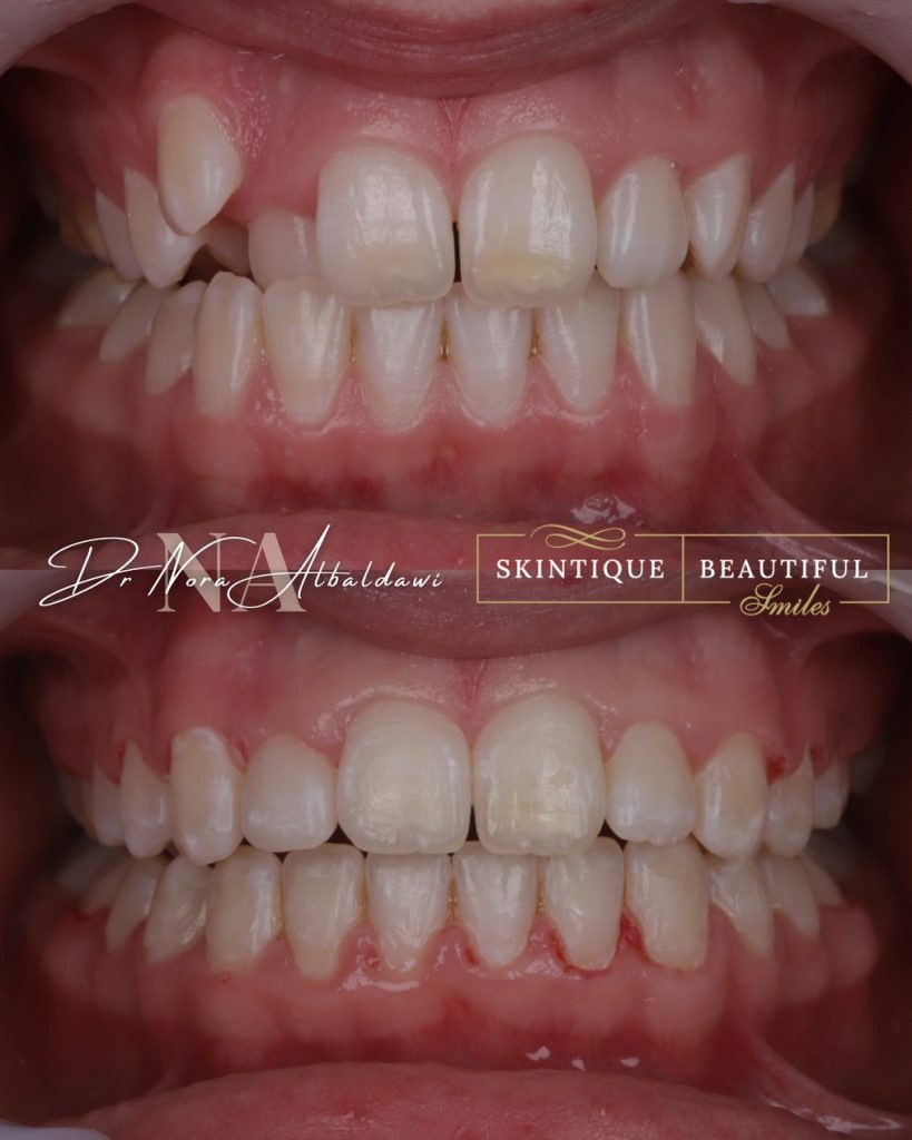 brooke's teeth before and after braces