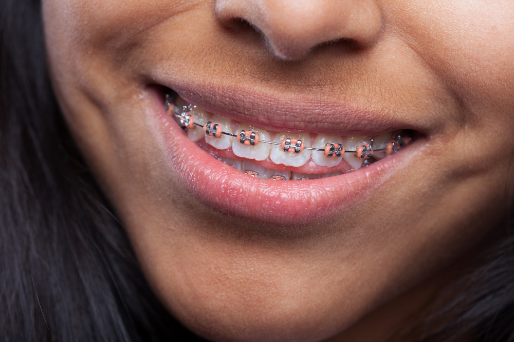 woman smiling with metal braces