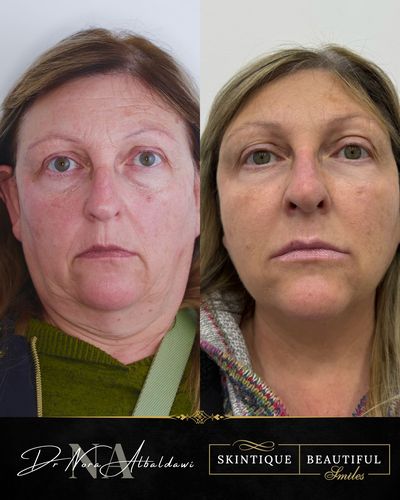 Bev 1, antiwrinkle injections, PDO thread lifting, fillers in cheeks, lips, nose