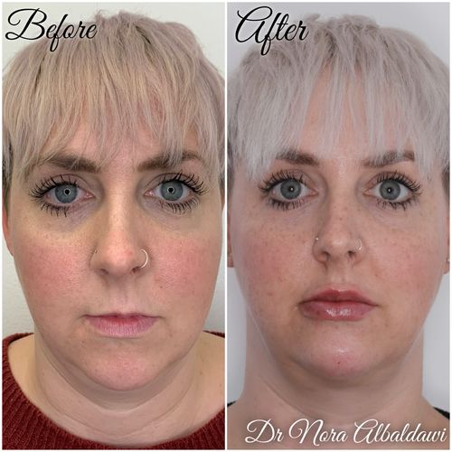 Bex 1, Fat dissolving injections and micro needling to reduce double chin and lips_chin fillers