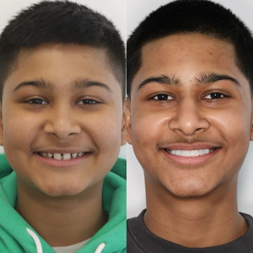 Jnay 1, fixed braces, composite bonding and fibre bridge to replace missing teeth