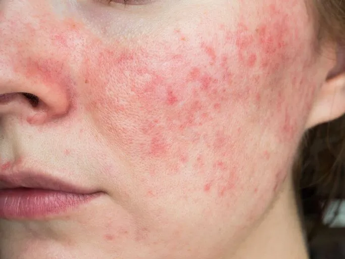 Rosacea / Facial Redness