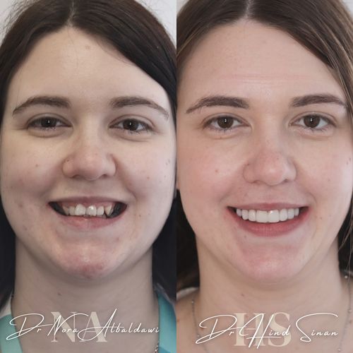 Sam 1, Damon clear braces, whitening, laser gum contouring and composite bonding