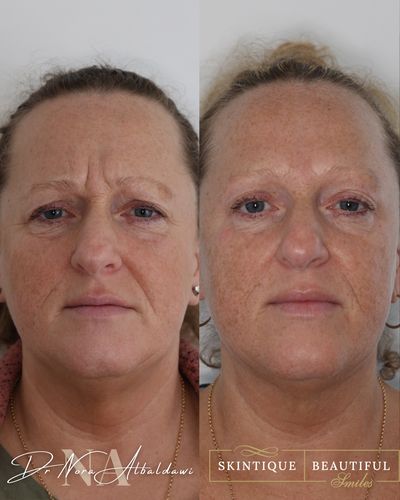Wendy 1, hydra facials, anti wrinkle injections and morpheus 8